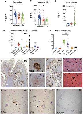 Hepcidin Increases Cytokines in Alzheimer’s Disease and Down’s Syndrome Dementia: Implication of Impaired Iron Homeostasis in Neuroinflammation